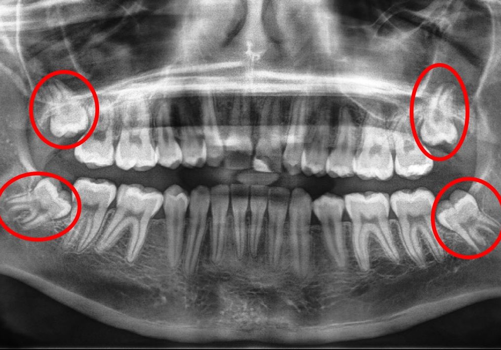 3rd Molar Panorex