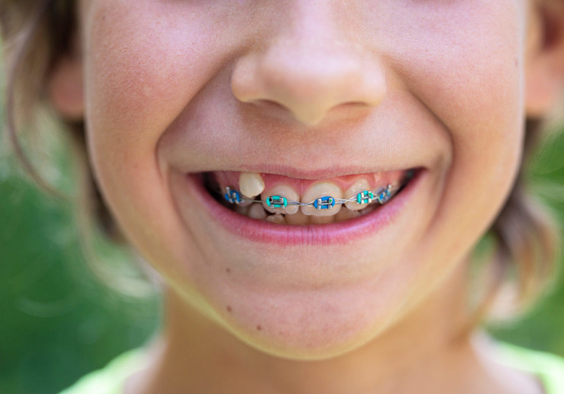 Exposure of teeth