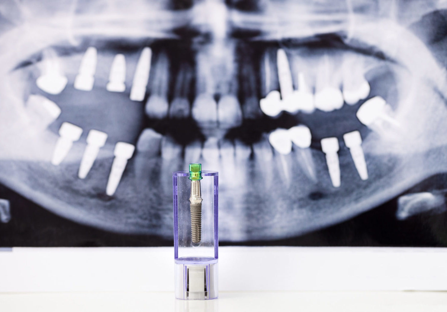 WTIC Implants