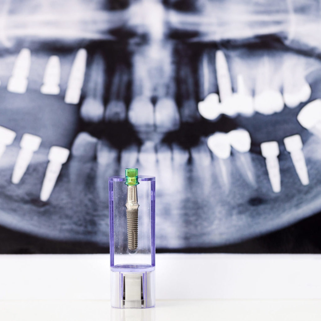 WTIC Implants